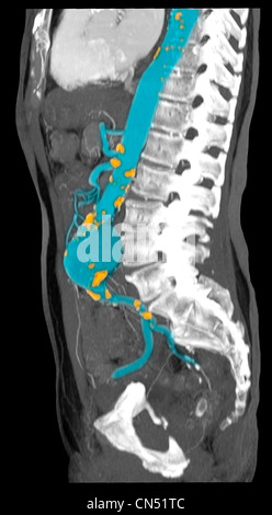 CT scanner des images montrant un anévrisme de l'aorte abdominale Banque D'Images