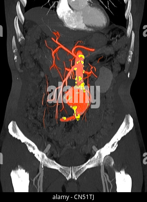 CT scanner des images montrant un anévrisme de l'aorte abdominale Banque D'Images