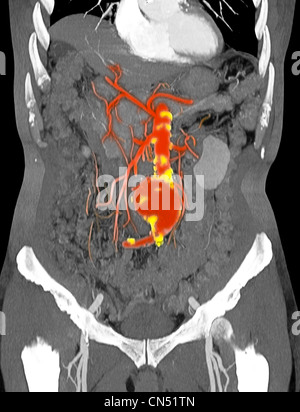 CT scanner des images montrant un anévrisme de l'aorte abdominale Banque D'Images