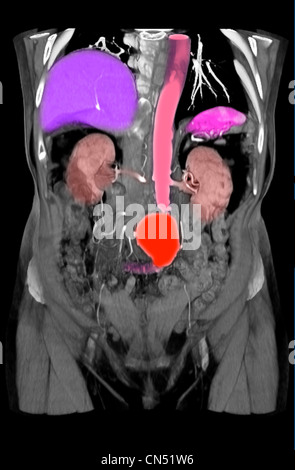 CT scanner des images montrant un anévrisme de l'aorte abdominale Banque D'Images