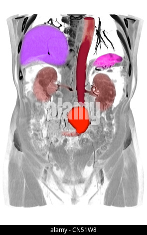 CT scanner des images montrant un anévrisme de l'aorte abdominale Banque D'Images