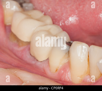 Macro Close up shot de l'intérieur de la bouche et les obturations et les couronnes sur les dents Banque D'Images