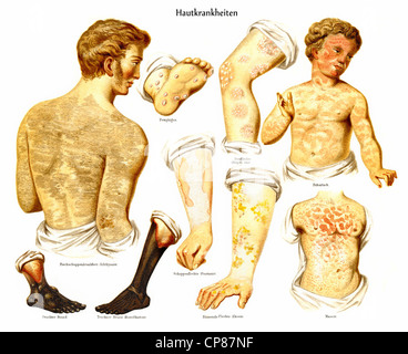 Les maladies de la peau, dermatoses, la rougeole, la scarlatine, le psoriasis, l'herpès, Historische, zeichnerische Darstellung, Hautkrankheiten (D Banque D'Images