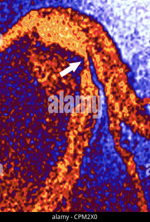 Infarctus du myocarde, ANGIOGRA. Banque D'Images