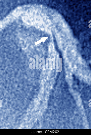 Infarctus du myocarde, ANGIOGRA. Banque D'Images