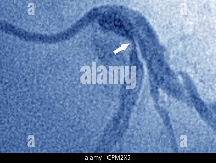 Infarctus du myocarde, ANGIOGRA. Banque D'Images