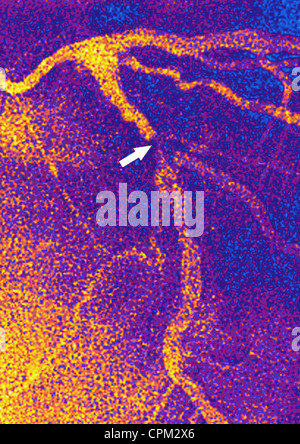 Infarctus du myocarde, ANGIOGRA. Banque D'Images