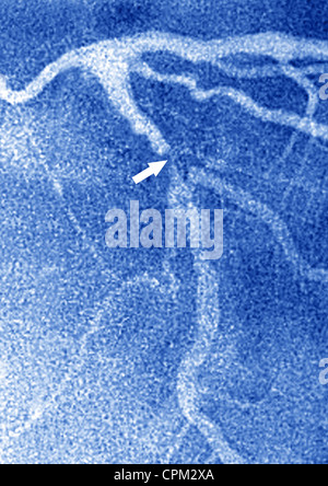 Infarctus du myocarde, ANGIOGRA. Banque D'Images