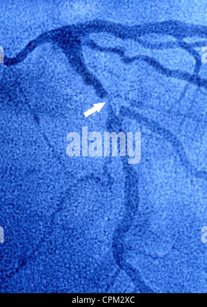 Infarctus du myocarde, ANGIOGRA. Banque D'Images