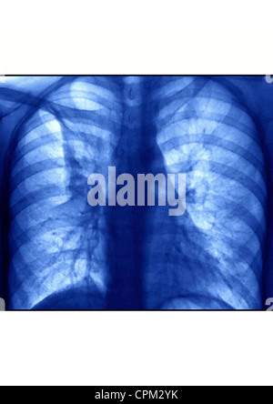 La bronchite, X-RAY Banque D'Images