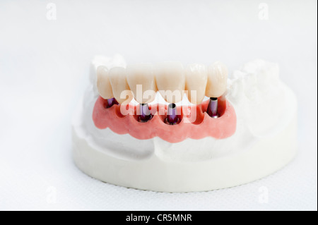 Les couronnes des dents sur les broches dans un modèle de la mâchoire Banque D'Images