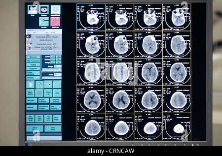 Sur l'image de l'écran d'un CT scan du cerveau d'un enfant de 5 ans souffrant de fibrose kystique. Banque D'Images