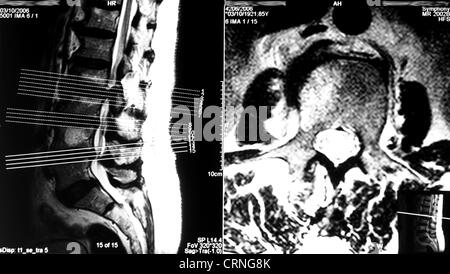 Une imagerie par résonance magnétique (IRM) montrent des signes de discarthrose et sténose spinale. Les disques entre d vertebraes L2-L5 sont clairement s'enflant dehors, avec le disque entre L2 et L3 montrant une hernie sur la moelle épinière. Le collagène II centre basé sur des disques intervertébraux est connu comme le noyau pulpo Banque D'Images