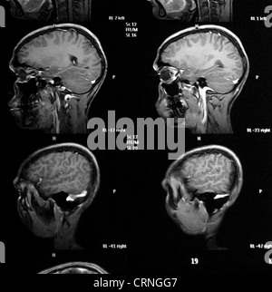 X-ray de patient atteint de cancer du cerveau Banque D'Images