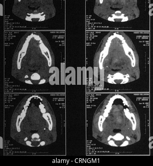 CT scan montrant la muqueuse buccale Eumycetoma dans la bouche du patient. La muqueuse buccale est la muqueuse de l'intérieur de la joue. Eumycetoma est la forme du mycétome fongique ; une maladie de la peau et du tissu conjonctif. Banque D'Images