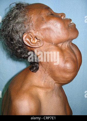 Patient a un goitre multinodulaire, un gonflement dans le cou juste en dessous de l'Adams apple (larynx) par une hypertrophie de la glande thyroïde. Banque D'Images