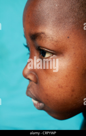 Vue de côté du visage d'une jeune fille de 12 ans souffrant de syndrome nephritic et la drépanocytose aneamia. Banque D'Images