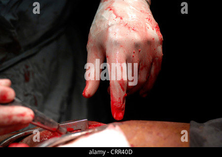 Close-up d'un gant de chirurgie tachée de sang pendant l'intervention. Banque D'Images