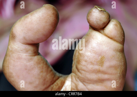 Close up d'un pied gauche avec les deuxième, troisième et quatrième orteils amputés. Banque D'Images