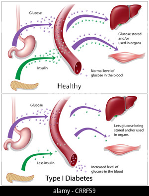 Illustration d'un diabète de type 1 Banque D'Images