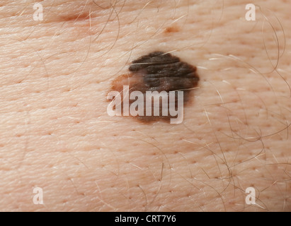 Un gros grain de beauté sur le dos d'un homme montrant des signes de mélanome, confirmé par la suite. Banque D'Images