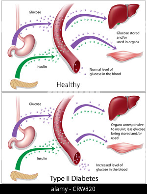 Schéma illustrant le diabète de type 2 par rapport aux niveaux de glucose de sang en bonne santé Banque D'Images