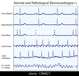 Collection ecg normaux et malades Banque D'Images