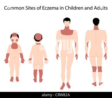 Des sites communs de l'eczéma chez les adultes et les enfants Banque D'Images