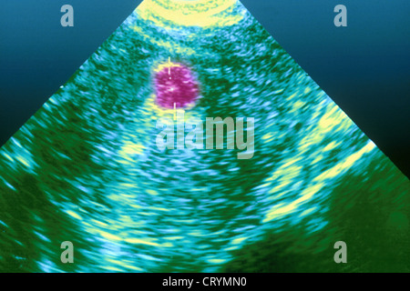 Fibrome utérin, l'échographie Banque D'Images