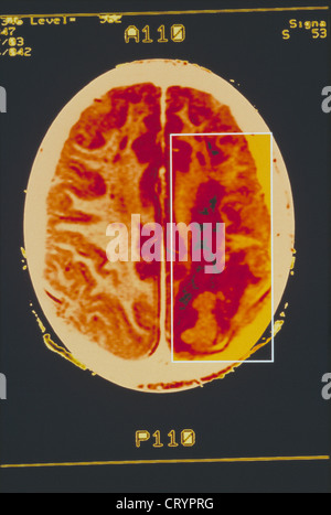 L'hémorragie, la scintigraphie cérébrale Banque D'Images