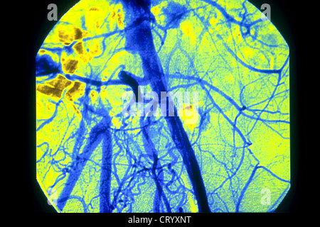 La thrombose iliaque, angiographie Banque D'Images