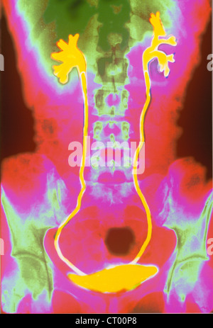 Système urinaire, X-RAY TROUVER Banque D'Images