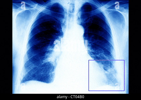 L'EMBOLIE PULMONAIRE RADIO Banque D'Images