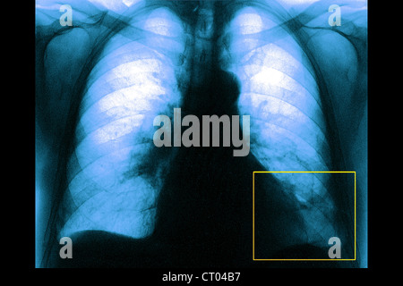 L'EMBOLIE PULMONAIRE RADIO Banque D'Images