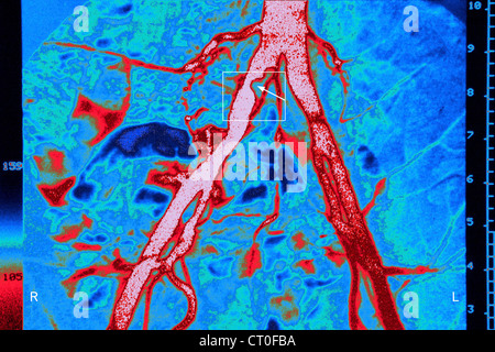 La sténose iliaque, angiographie Banque D'Images