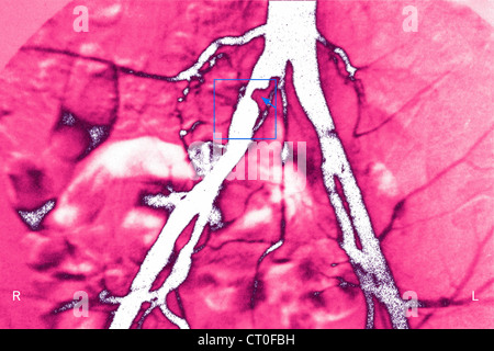 La sténose iliaque, angiographie Banque D'Images