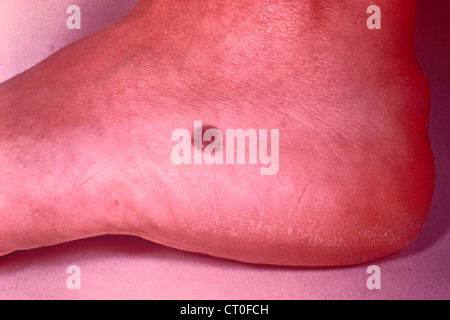 Le m lanome malin Photo Stock Alamy