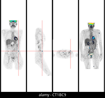 Le LYMPHOME DU MALT, PETSCAN Banque D'Images