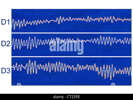 La fibrillation ventriculaire, ECG Banque D'Images