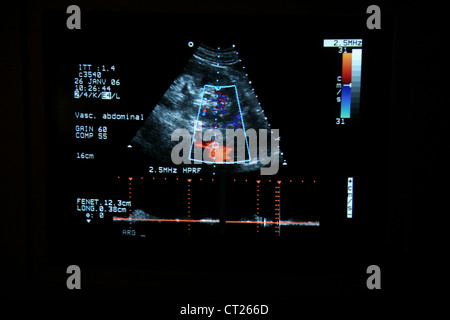 L'artère rénale, l'ÉCHOGRAPHIE DOPPLER Banque D'Images