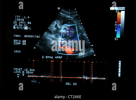 L'artère rénale, l'ÉCHOGRAPHIE DOPPLER Banque D'Images