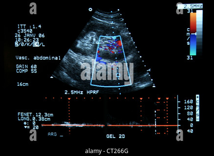 L'artère rénale, l'ÉCHOGRAPHIE DOPPLER Banque D'Images