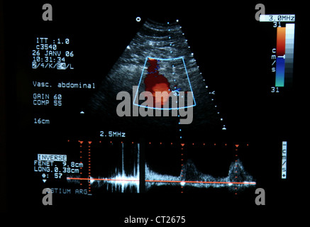 L'artère rénale, l'ÉCHOGRAPHIE DOPPLER Banque D'Images