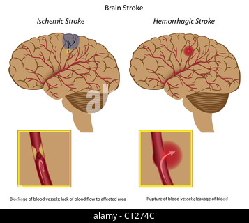 Accident vasculaire cérébral Banque D'Images