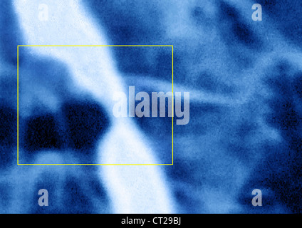 La sténose iliaque, angiographie Banque D'Images