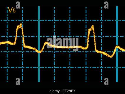 Bloc de branche, de l'ECG Banque D'Images