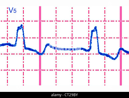 Bloc de branche, de l'ECG Banque D'Images