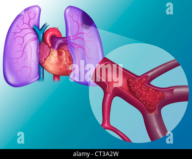 L'embolie pulmonaire, dessin Banque D'Images