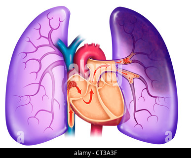 L'embolie pulmonaire, dessin Banque D'Images