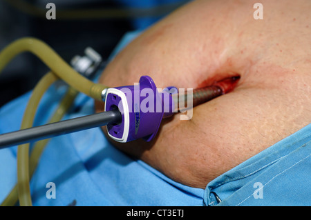 Un port laparoscopic placés dans une cavité abdominale du patient. Cela va gonfler l'abdomen avec du dioxyde de carbone. Banque D'Images